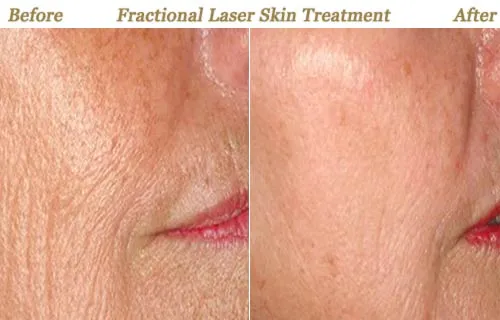 1540 Fractional Non-Ablative Laser